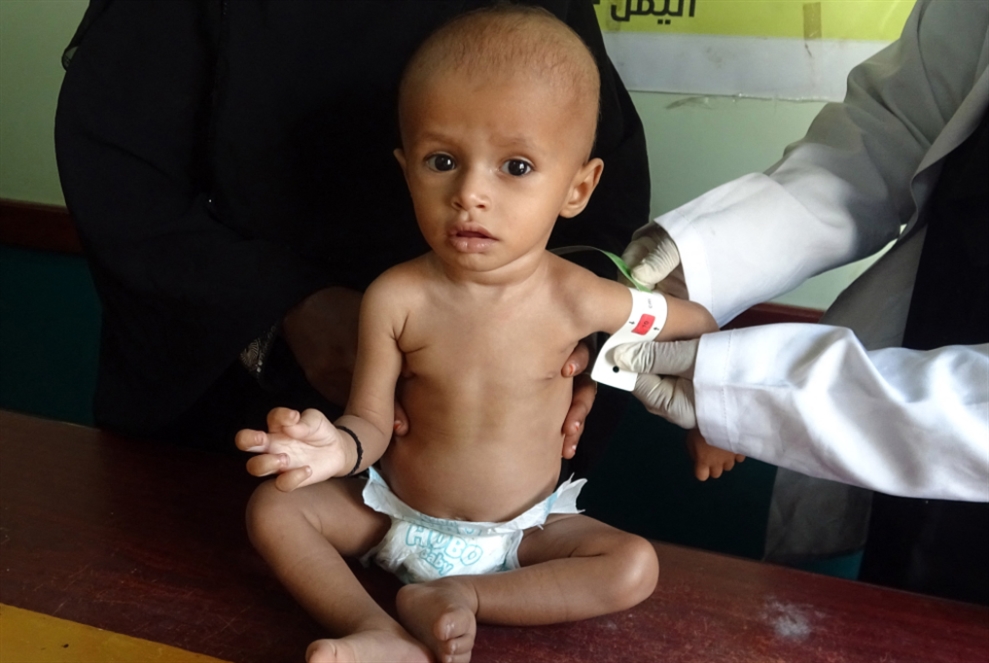 «الصحة العالمية»: 75% من أطفال اليمن يعانون سوء التغذية المزمن