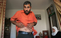 فلسطيني يعرض آثار تعذيب بعد اعتقاله من قبل السلطة في الضفة (ناصر اشتيه - أ ب)