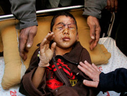 الطفل لؤي صبح الذي فقد عينيه بغارة إسرائيلية (اسماعيل زايده ــ رويترز)